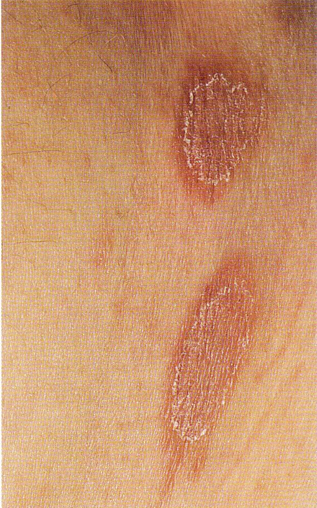 Flecken der brust zwischen rote Hautausschlag (Exanthem):